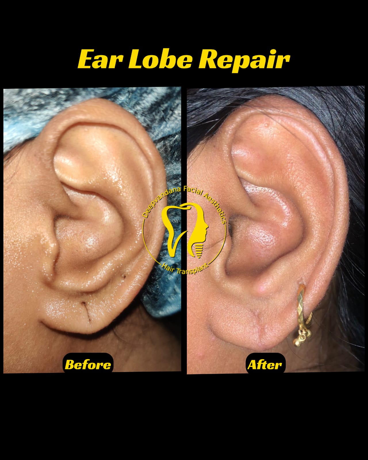 Earlobe Repair