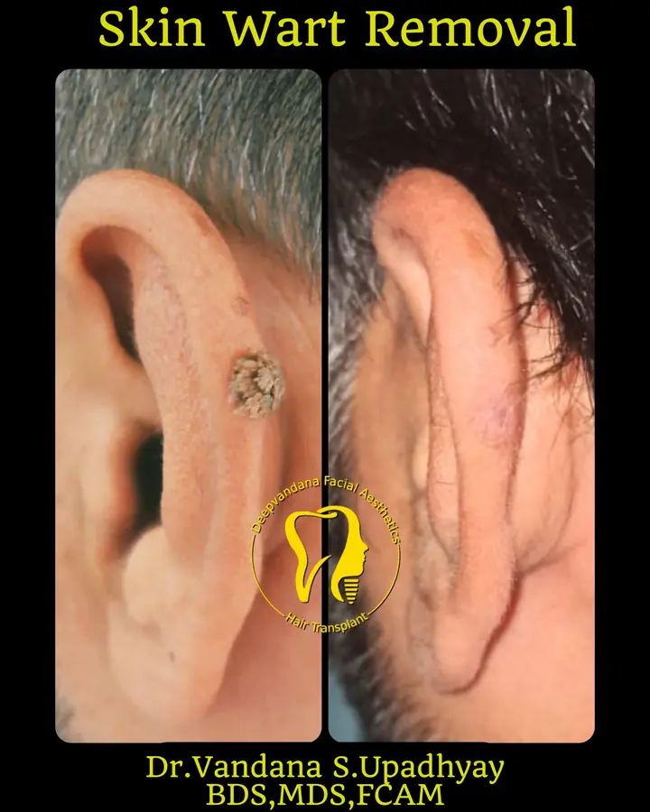 Skin wart removal case