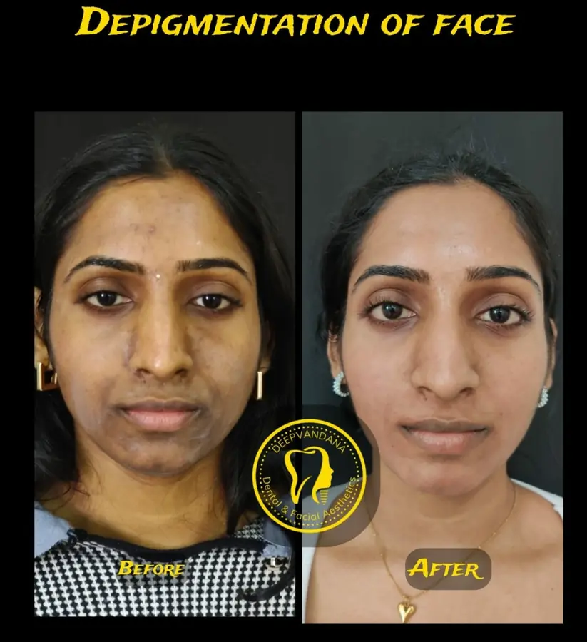 Depigmentation of face