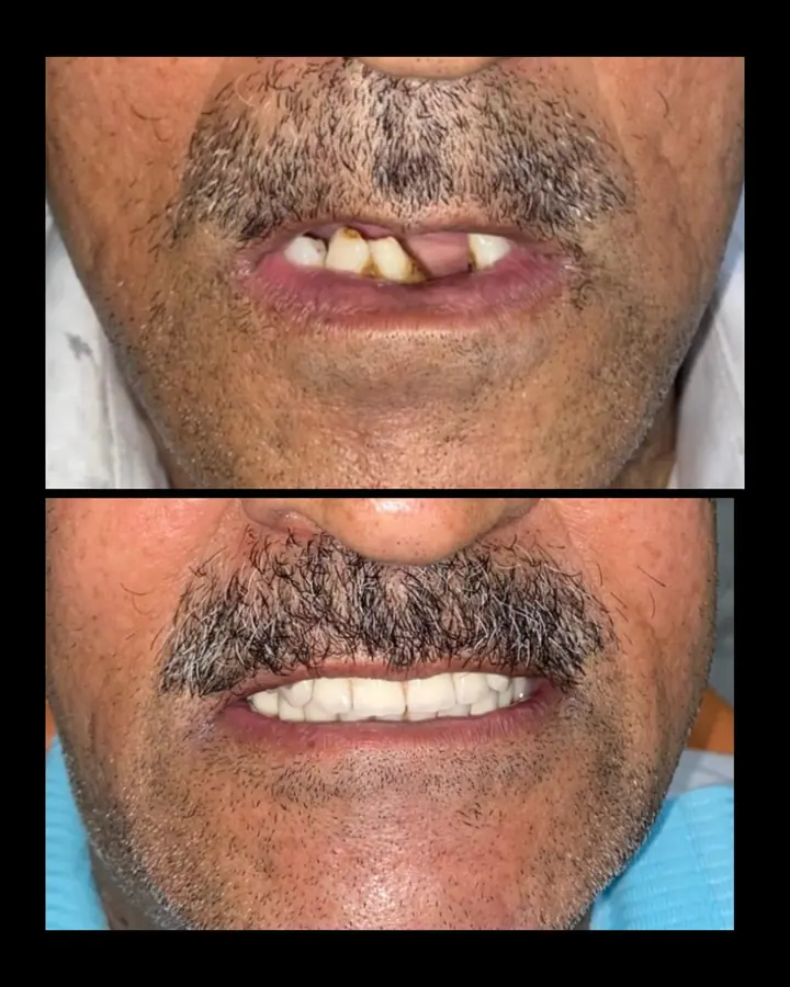 Implant smile transformation