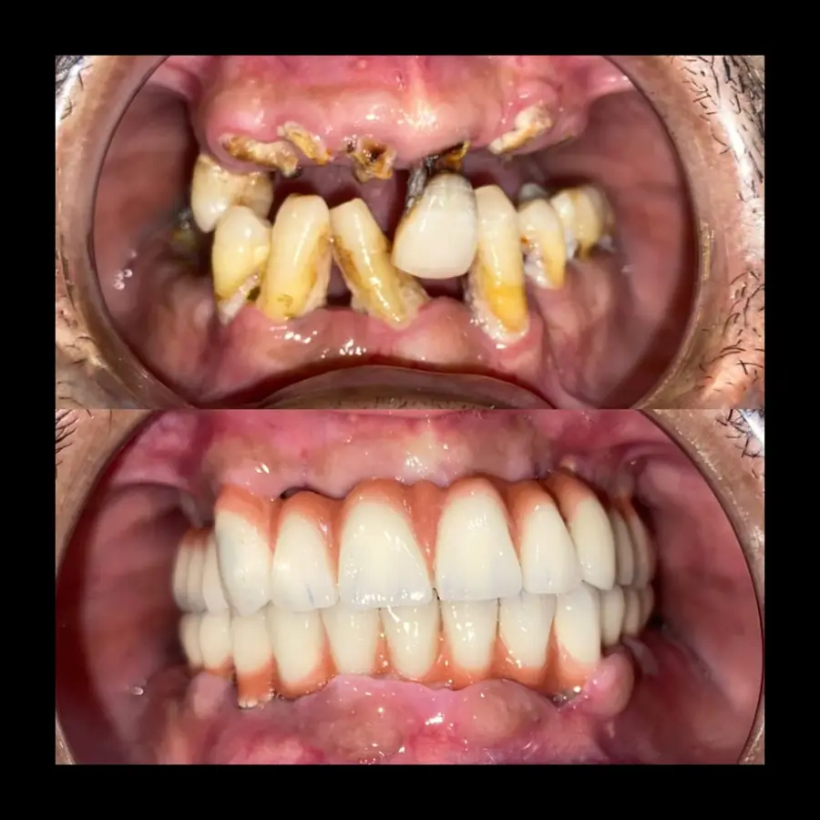 Full-mouth rehabilitation close-up