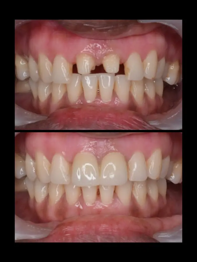 Smile makeover case 4